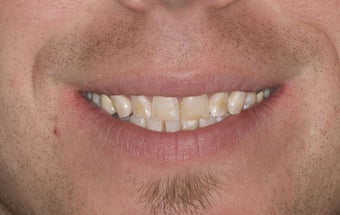 Composite Bonding and Porcelain Crowns before 374723