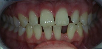 Porcelain Veneers and Composite Bonding before 374753