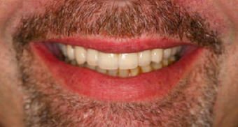 Full Porcelain Crowns after 109490