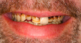 Full Porcelain Crowns before 109490