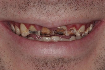 Full Mouth Reconstruction before 382036