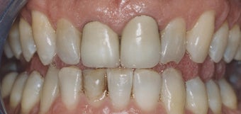 Dental Crowns and Teeth Whitening before 485403
