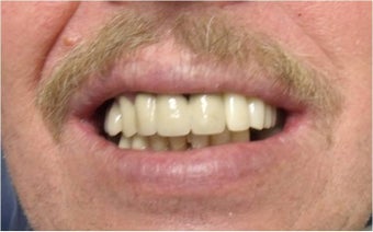 Mini Dental Implants replacing missing teeth after 402367