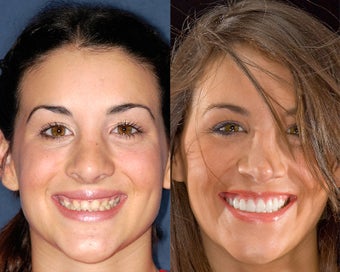 Implants restored with porcelain crowns before 324162