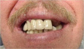 Mini Dental Implants replacing missing teeth before 402367