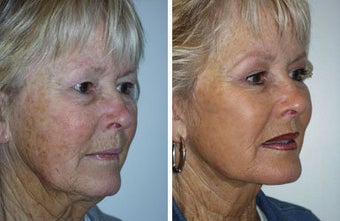 Facelift with dermabrasion before 91403