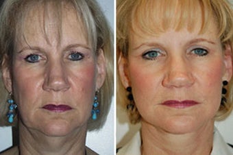 Face lift with dermabrasion before 91405