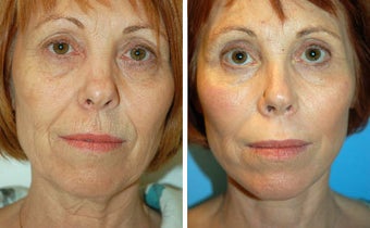 Facelift before 91420