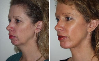 Facelift with Chin Implant, Dermabrasion before 91929