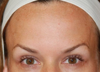 Dysport in the horizontal forehead lines. after 624778
