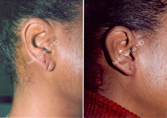 Earlobe Surgery before 243307