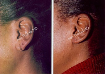 Earlobe Surgery before 243309