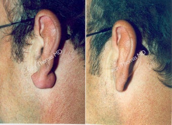 Earlobe Surgery before 243321