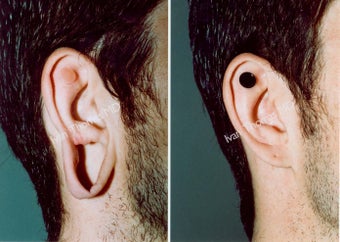 Earlobe Surgery before 243327