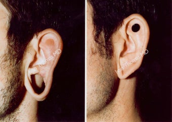 Earlobe Surgery before 243328