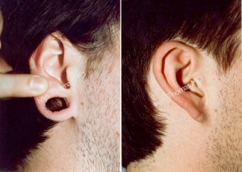 Earlobe Surgery before 243334