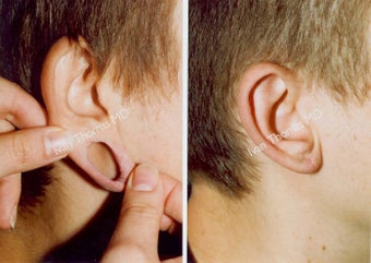 Earlobe Surgery before 243337