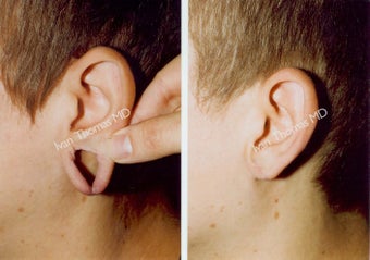 Earlobe Surgery before 243338