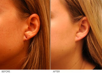 Earlobe Repair- left before 291709