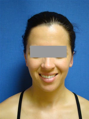 Ear Surgery (otoplasty) after 124877