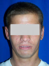 Ear Surgery (otoplasty) after 130069