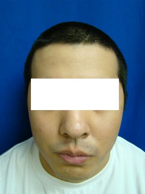 Ear Surgery (otoplasty) after 135282