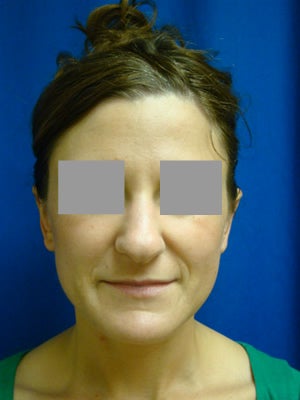 Ear Surgery (Otoplasty) after 145188