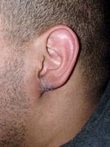 Ear Surgery after 146610