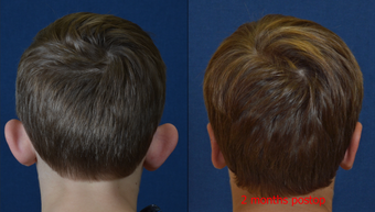 9 Year Old Male Child Treated for Prominent Ears after 639870