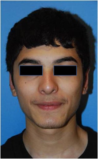 Before and after Otoplasty / Ear Reshaping after 90112