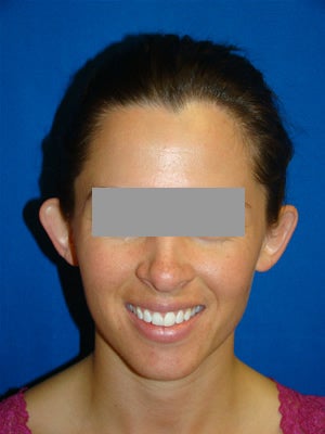 Ear Surgery (otoplasty) before 124877