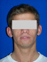 Ear Surgery (otoplasty) before 130069