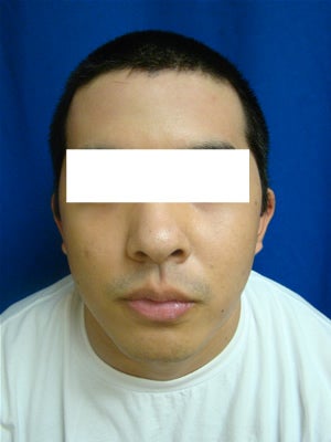 Ear Surgery (otoplasty) before 135282