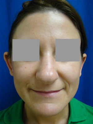 Ear Surgery (Otoplasty) before 145188