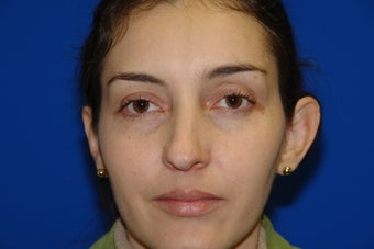 Otoplasty before 284039