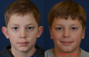 9 Year Old Male Child Treated for Prominent Ears before 639870
