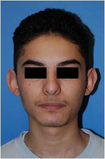 Before and after Otoplasty / Ear Reshaping before 90112