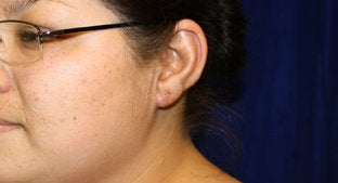 Ear lobe Keloid after 494478