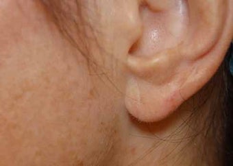 Earlobe Repair after 513410