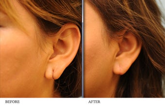Torn earlobe repair before 436483