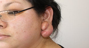 Ear lobe Keloid before 494478