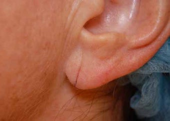 Earlobe Repair before 513410