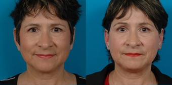 Earlobe Reduction before 574451