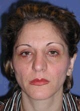 Ear Surgery (Otoplasty) after 357648