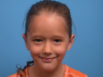 Otoplasty after 418922