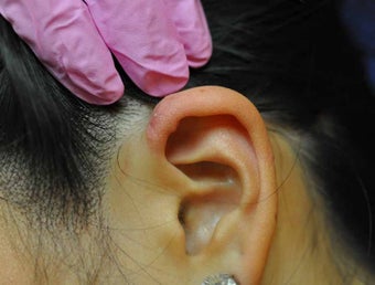 Keloid Removal after 513407
