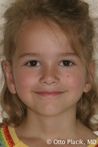 Otoplasty after 567524