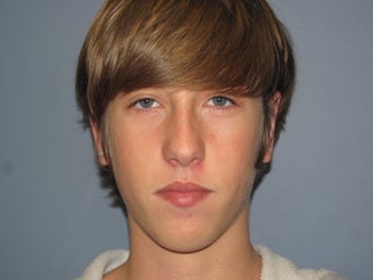 Otoplasty after 577409