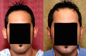 Otoplasty or ear push back surgery after 583653