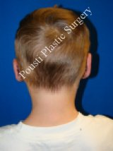Ear Surgery (Otoplasty) after 616658
